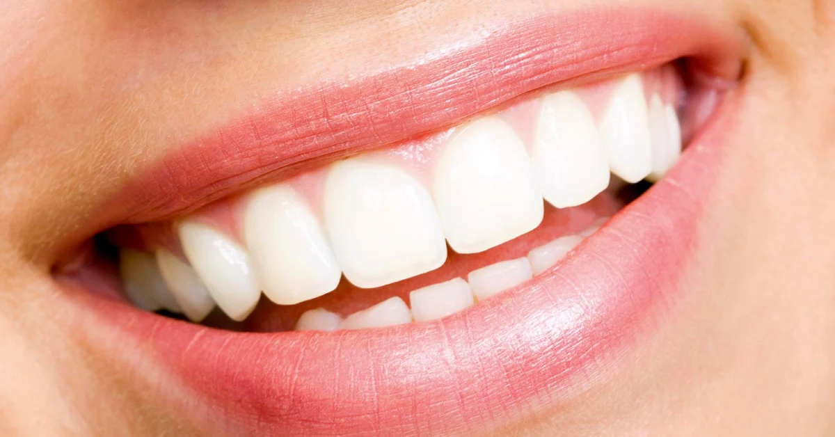 Bleaching - Teeth Whitening