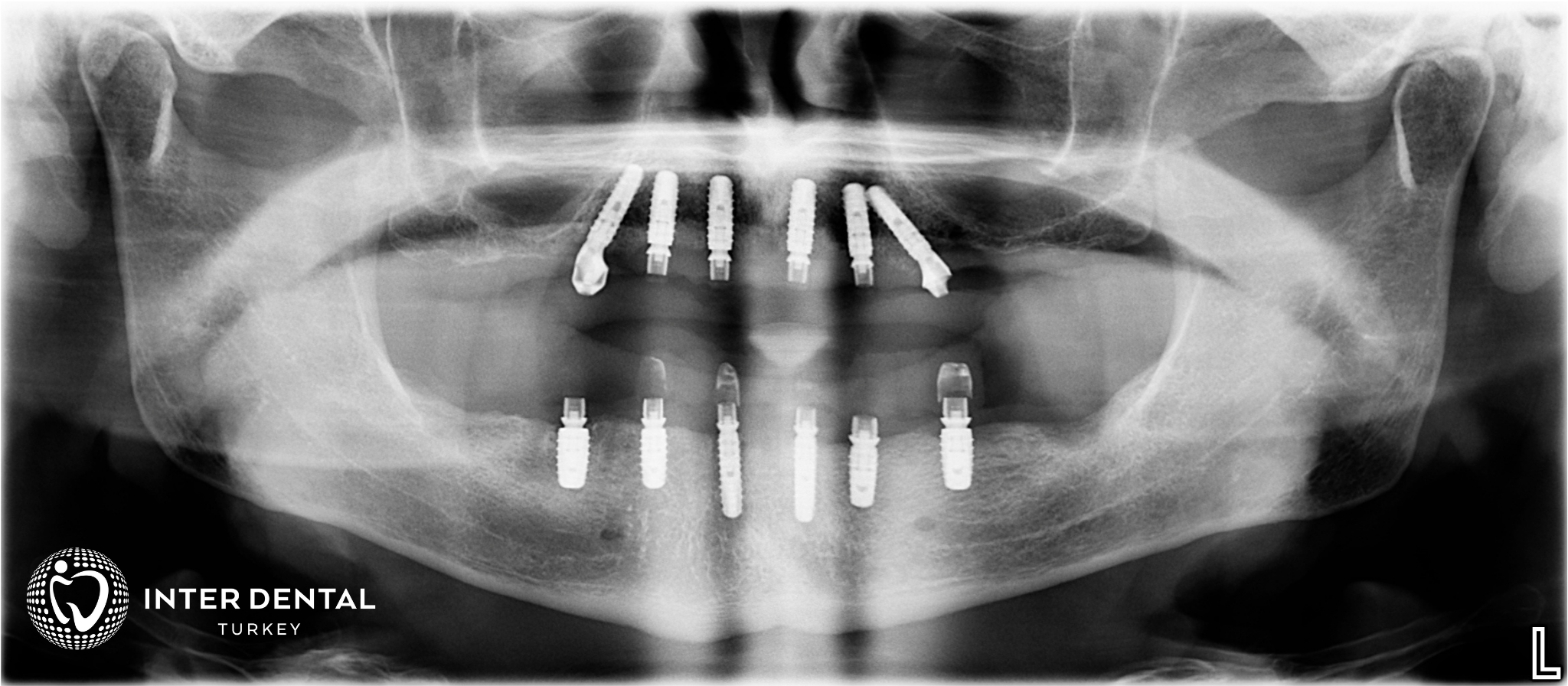 Panoramaröntgenbild und Planung der All-on-Six Implantat-Behandlung