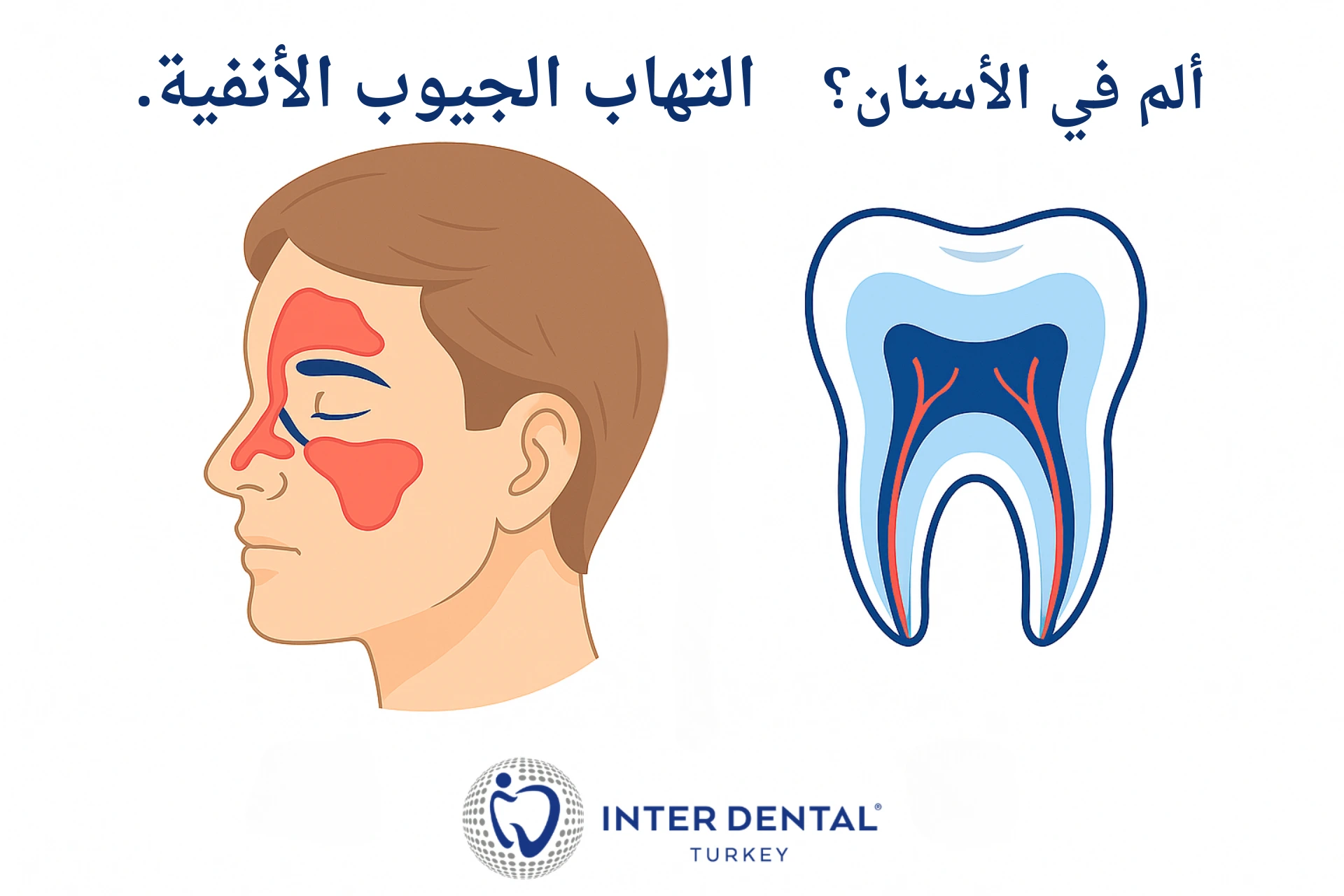 التهاب الجيوب الأنفية أم ألم الضرس: كيف تميز ألم الأسنان العلوية؟
