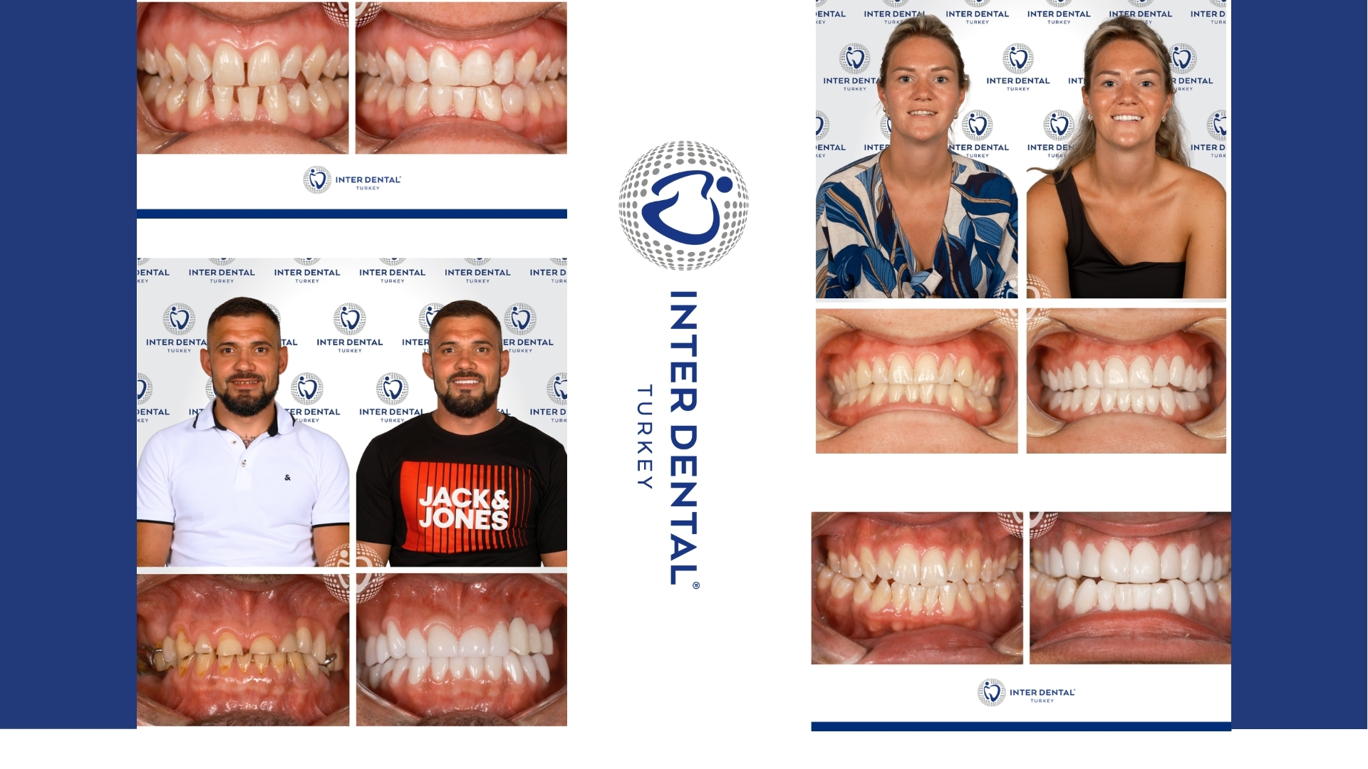 Before and after dental tourism photo red flags