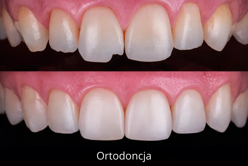 Porównanie przed i po bondingu kompozytowym pokazujące poprawę kształtu zębów, krawędzi i symetrii uśmiechu