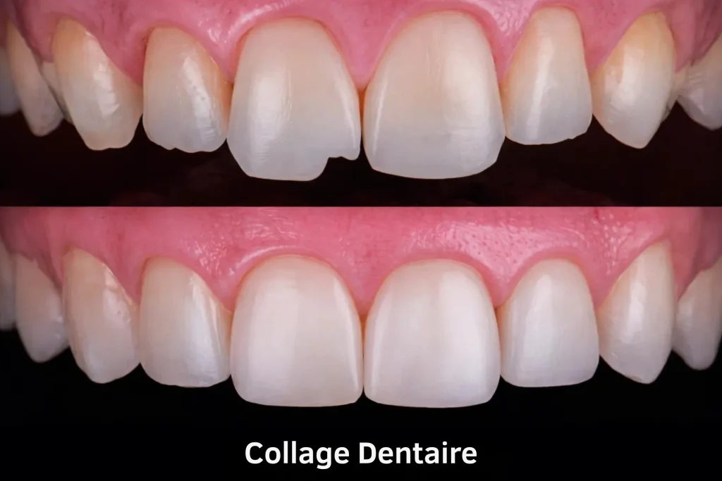 Avant/après du bonding dentaire en composite montrant une amélioration de la forme, des bords et de l’harmonie du sourire