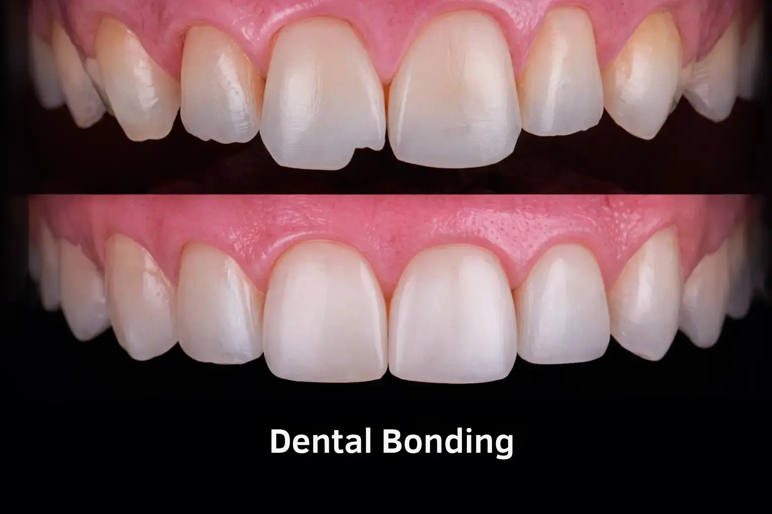 Dental bonding before and after composite resin smile enhancement