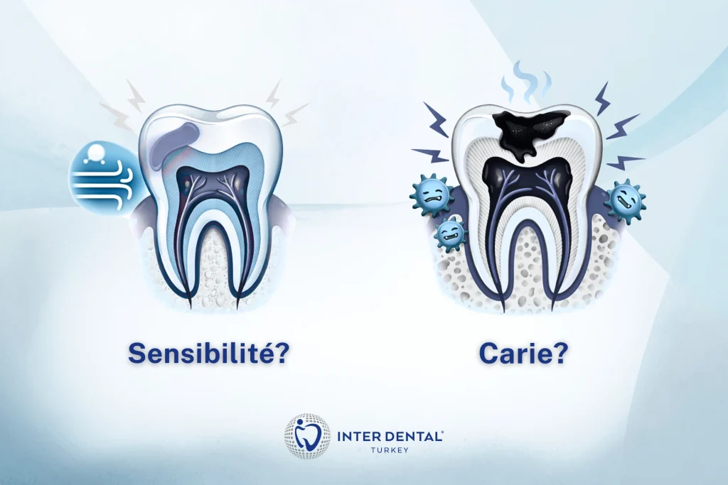 Comparaison des signes entre une dent sensible et une carie (froid, sucré, douleur persistante, douleur en mordant)