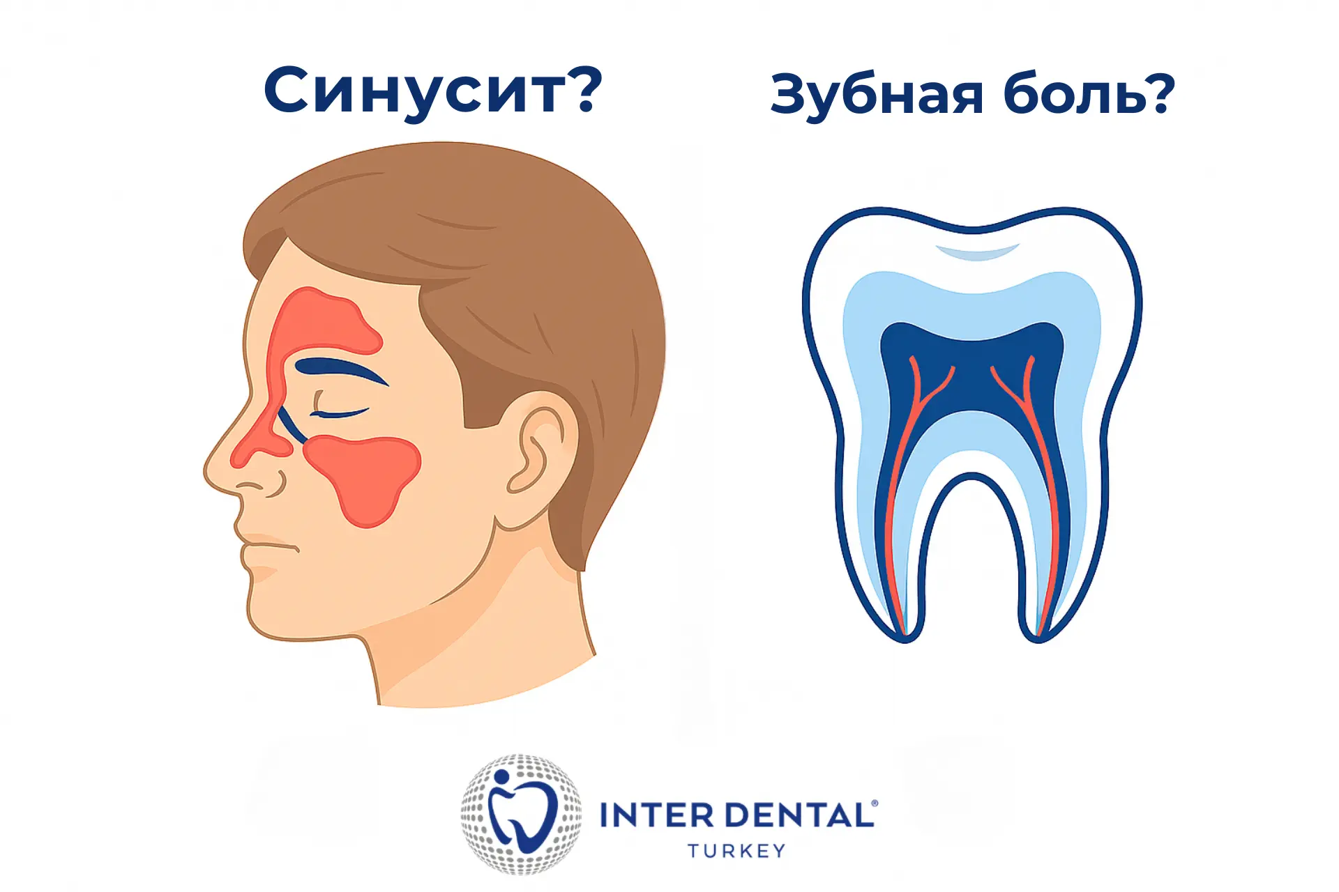 Синусит или зубная боль: как отличить боль в верхних зубах