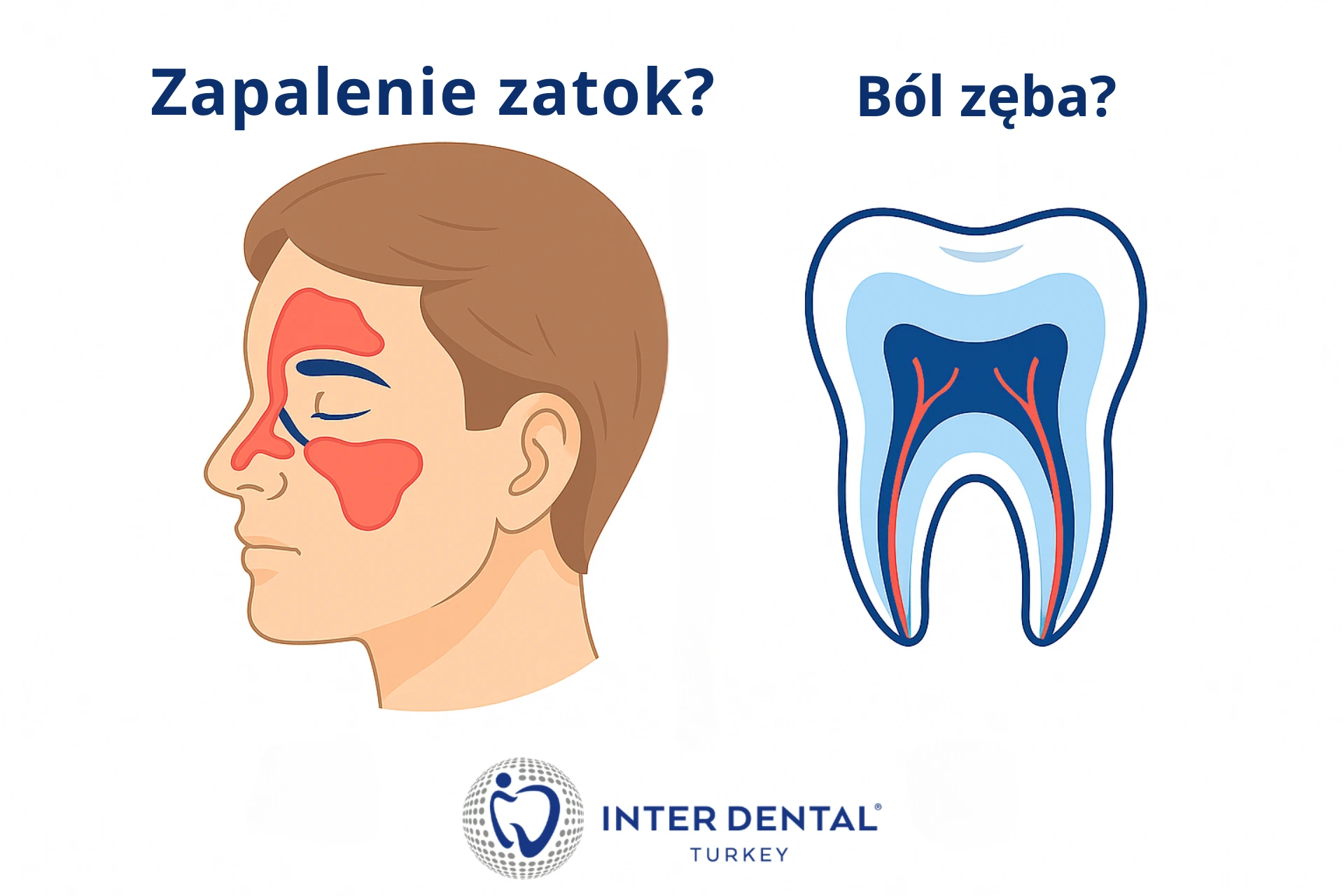 Ból zębów górnych: zatoki czy ząb? (wskazówki)