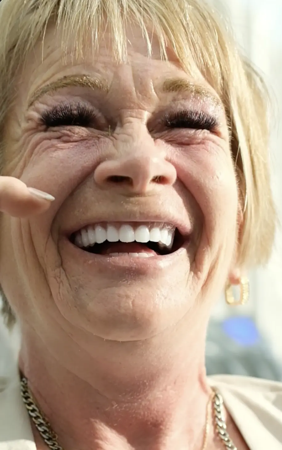 Cornelia, All-on-six dental implant patient at Inter Dental Turkey
