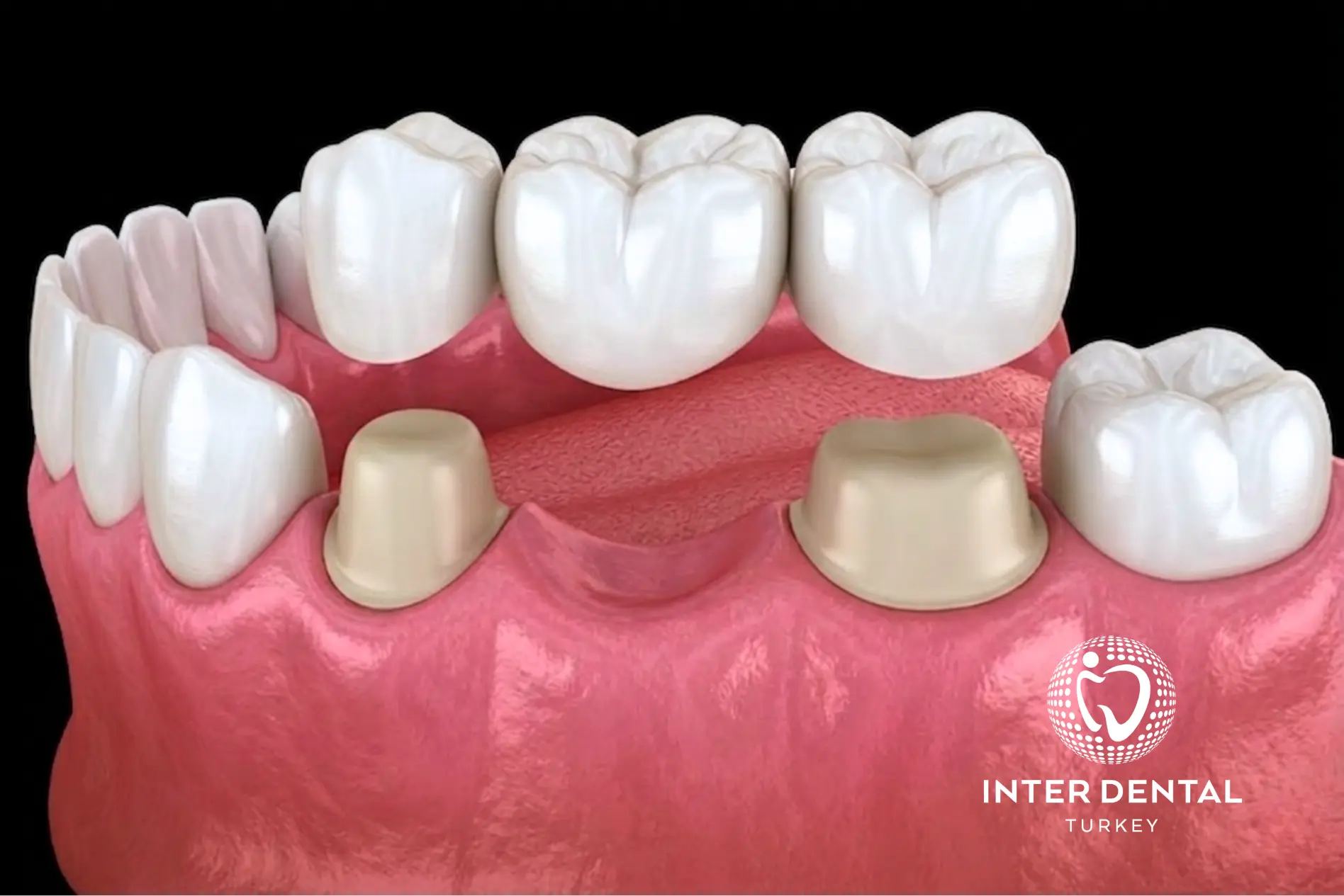 جسور الأسنان