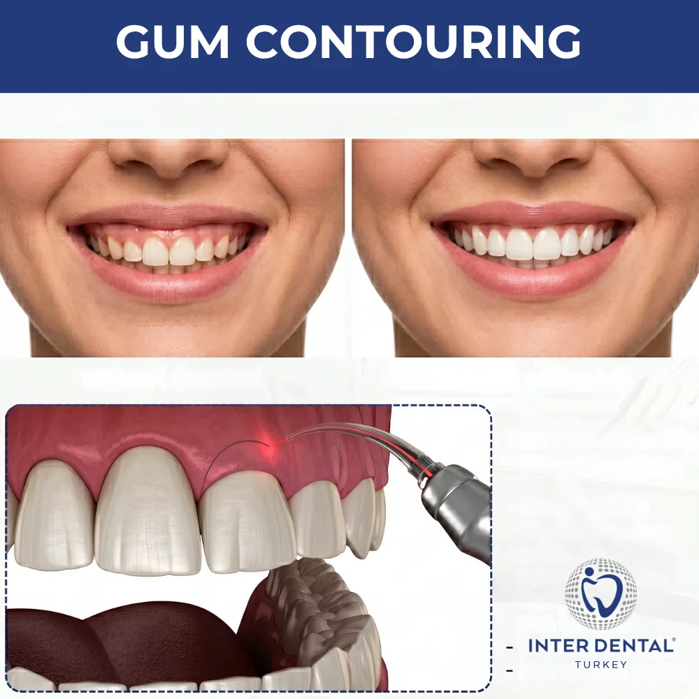 Лазерная коррекция десны и Розовая эстетика в клинике Inter Dental Turkey