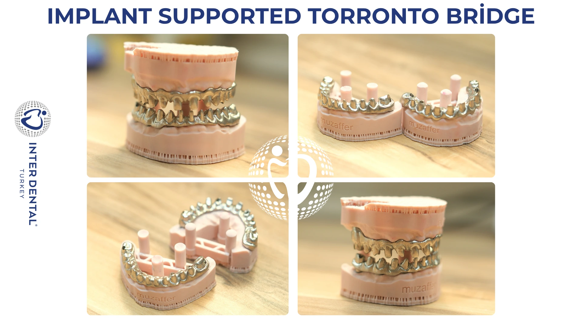 Puente Toronto fijo sobre implantes con Estética Rosa