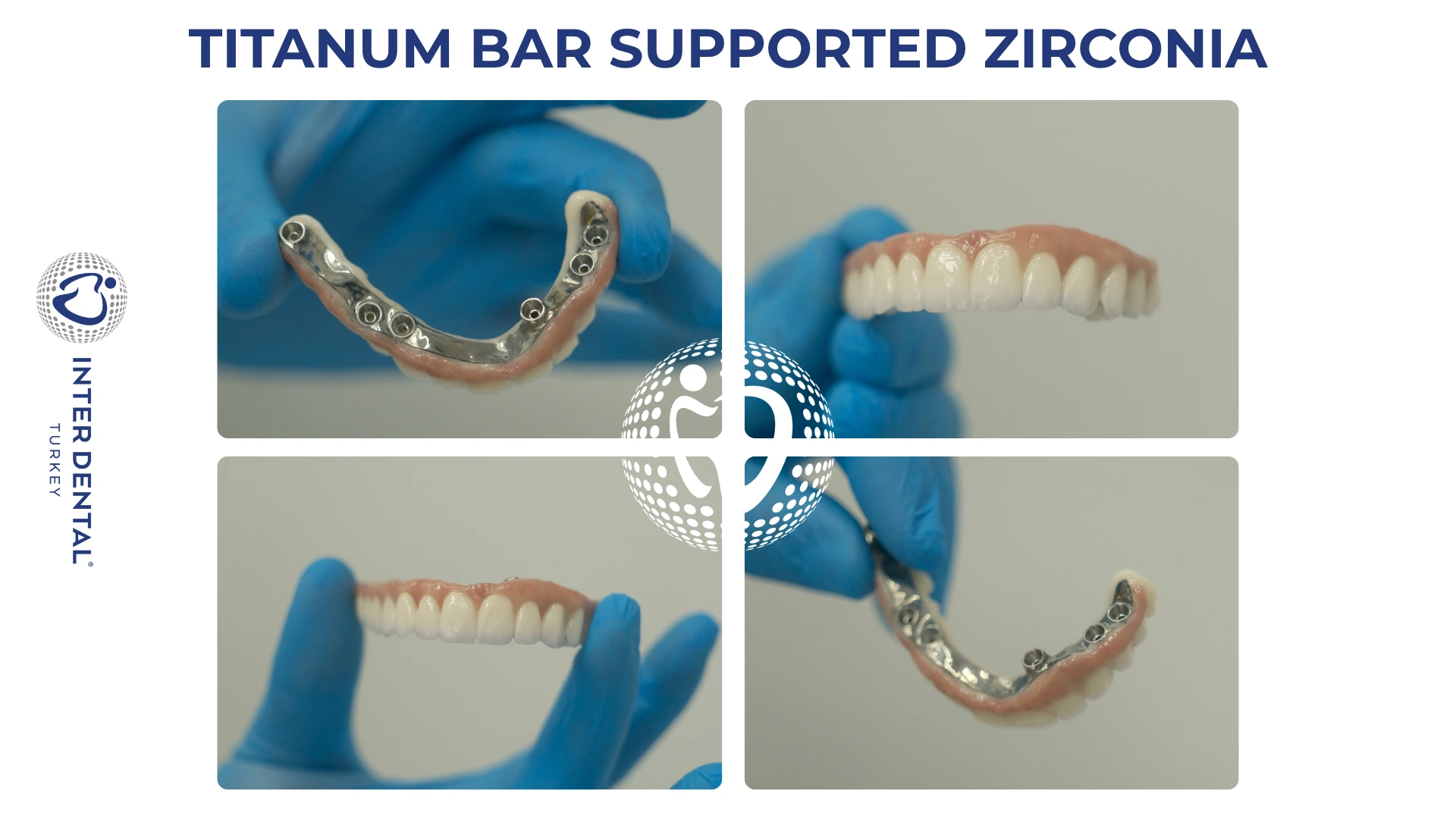 Individuell gefräster Titansteg bei Inter Dental Turkey