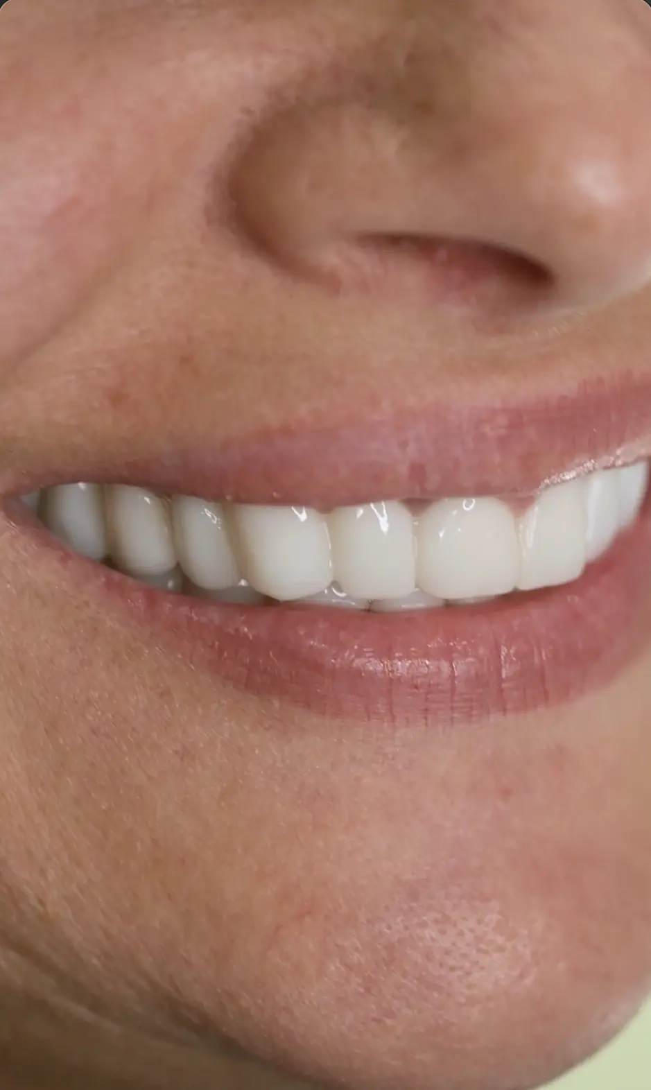 Olga, dental veneers patient at Inter Dental Turkey