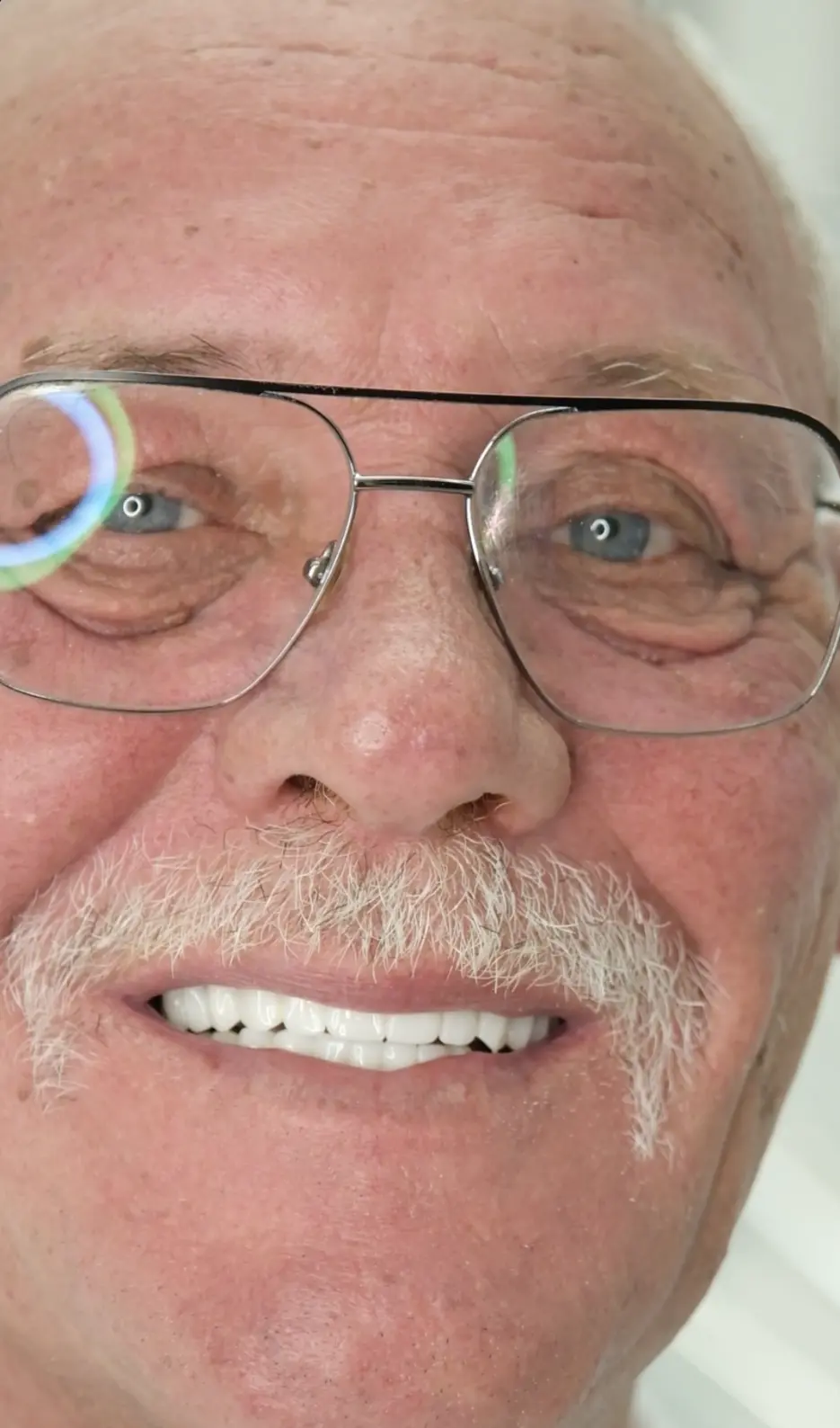 Richard, All-on-six dental implant patient at Inter Dental Turkey