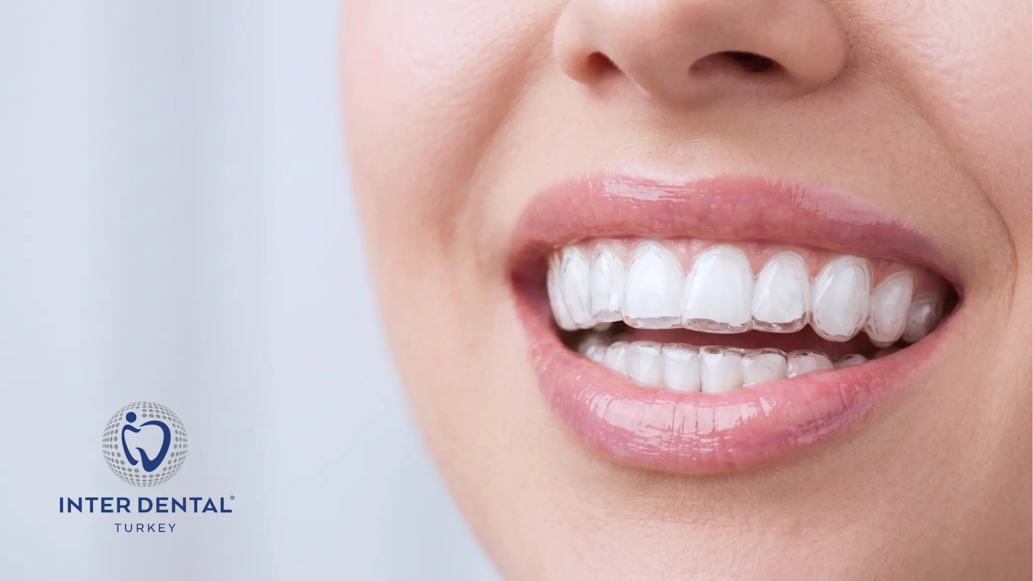 Gros plan d'un patient souriant suivant un traitement orthodontique par gouttières transparentes Invisalign à la clinique Inter Dental Turkey.