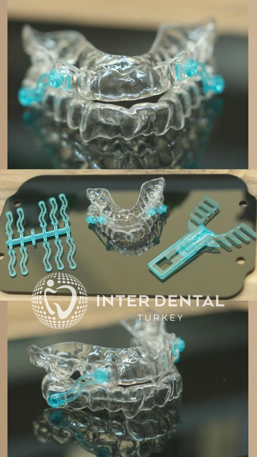 Custom-made anti-snoring mandibular advancement device with precision adjustment components at Inter Dental Turkey Side Antalya